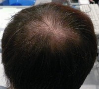 Tratamentul alopeciei, transplantul de par Ekaterinburg, Perm, Chelyabinsk, Nizhny Tagil, Tyumen, Ufa,