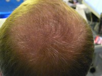 Tratamentul alopeciei, transplantul de par Ekaterinburg, Perm, Chelyabinsk, Nizhny Tagil, Tyumen, Ufa,