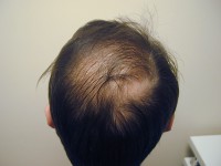 Tratamentul alopeciei, transplantul de par Ekaterinburg, Perm, Chelyabinsk, Nizhny Tagil, Tyumen, Ufa,