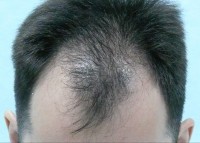 Tratamentul alopeciei, transplantul de par Ekaterinburg, Perm, Chelyabinsk, Nizhny Tagil, Tyumen, Ufa,