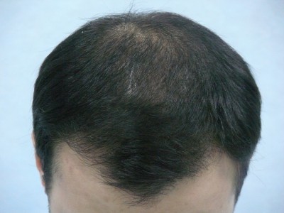 Tratamentul alopeciei, transplantul de par Ekaterinburg, Perm, Chelyabinsk, Nizhny Tagil, Tyumen, Ufa,