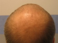 Tratamentul alopeciei, transplantul de par Ekaterinburg, Perm, Chelyabinsk, Nizhny Tagil, Tyumen, Ufa,