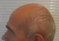 Tratamentul alopeciei, transplantul de par Ekaterinburg, Perm, Chelyabinsk, Nizhny Tagil, Tyumen, Ufa,