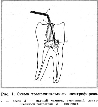 Tratamentul parodontitei utilizând electroforeza transcanală