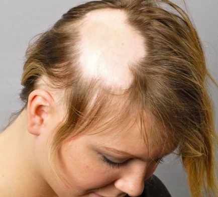 Tratamentul pierderii crescute a părului la femei