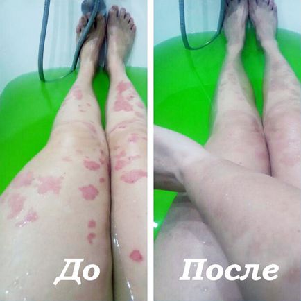 Tratamentul psoriazisului cu sare marină, eficacitate și aplicare