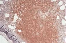 Kis sejtes limfóma (diffúz) leírása a betegség, a tünetek, kezelési ajánlások (limfóma) Kis sejtes limfóma (diffúz) leírása a betegség, a tünetek, kezelési ajánlások
