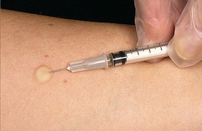 Манту склад вакцини і дію на людину