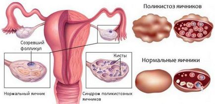 Lunar după chisturile laparoscopice ale ovarelor și trompelor uterine