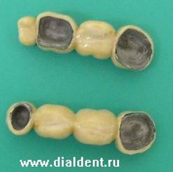 Ceramica metalica, preturi cermet, dinti metal-ceramici, coroane metal-ceramice,