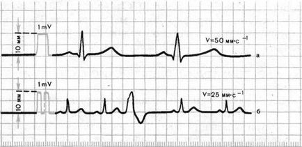 Metodă de înregistrare a electrocardiogramei