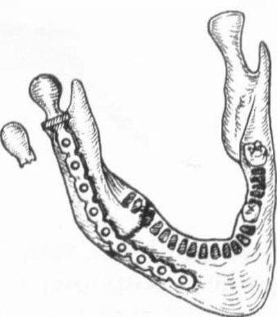 Metode de tratament a anchiloză a articulației temporomandibulare