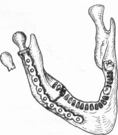 Методи лікування анкілозу скронево-нижньощелепного суглоба