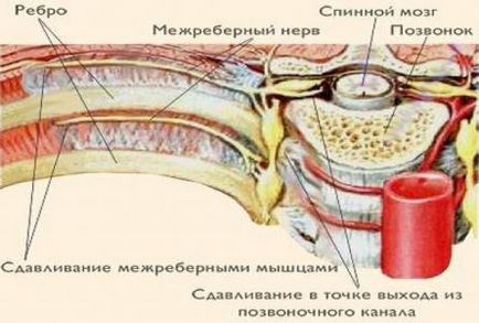 Simptomele nevralgiei intercostale, cauze, tratament