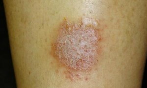 Eczema microbiană tratament modern, simptome, fotografie eczemă