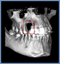 Миш'як в стоматології миш'яковистий некроз щелепи