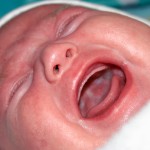Молочниця у новонароджених - причини і що робити, поради лікарів