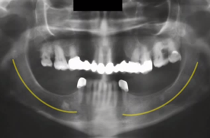 Este posibilă combinarea implantului și a dinților nativi