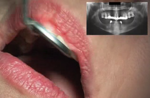 Este posibilă combinarea implantului și a dinților nativi