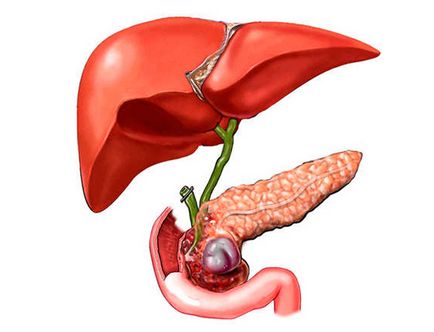 Diuretice populare pentru hipertensiune arterială, umflare și scădere în greutate