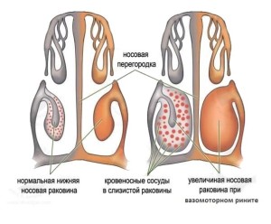 Народні засоби від нежитю і закладеності носа