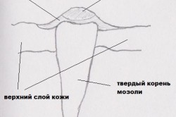 Натоптиші на ногах причини, симптоми, лікування