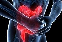 A colitis ulcerosa - mi ez (colitis) A colitis ulcerosa - mi ez