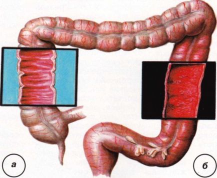 Colită ulcerativă nespecifică - handicap, complicații, prognostic, consecințe, ceea ce este periculos