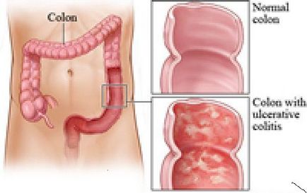 Colită ulcerativă nespecifică - handicap, complicații, prognostic, consecințe, ceea ce este periculos