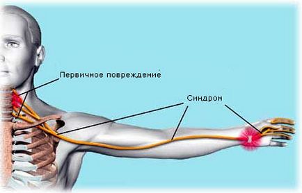 Нейроваскулярной синдром симптоми, ознаки, діагностика та лікування