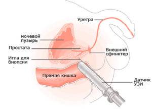 Dimensiuni normale de adenom de prostată