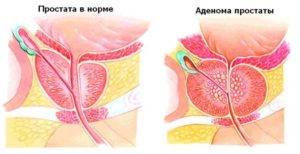 dimensiunile normale ale prostatei)