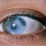 Нові методи лікування глаукоми - ваш доктор айболит
