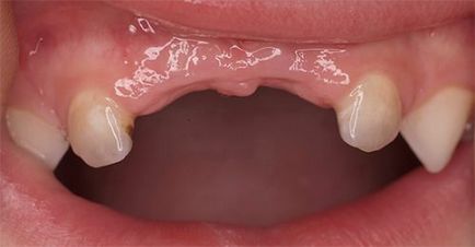 Чи потрібно пломбувати молочні зуби кращі пломбувальні матеріали