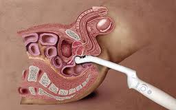 Determinarea dimensiunii normei și deviației glandei prostatei