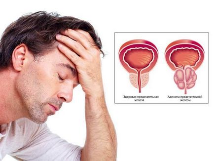 Determinarea dimensiunii normei și deviației glandei prostatei