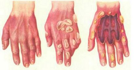 Ardeți cu acid sulfuric - prim ajutor și tratament