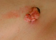 Papillóma kezelés a láb (Van is használható) Papilloma a lábát kezelés