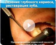 Parodontoliza în cazul sindromului Papillon-Lefebvre