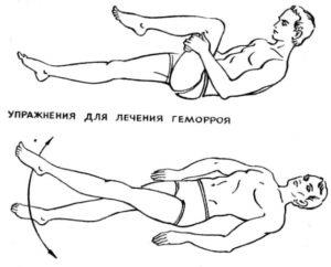 Перша швидка допомога при геморої в домашніх умовах