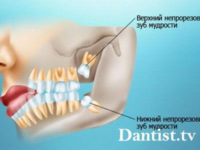 Пломбування зуба мудрості ціна і фото