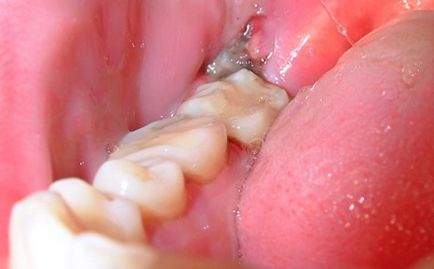 Пломбують зуби мудрості, чи варто лікувати або краще видалити