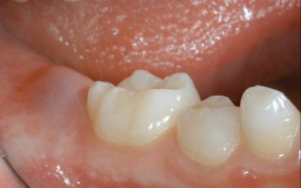 Dacă se umple dinții de înțelepciune, dacă este necesar să se trateze sau mai bine să se elimine