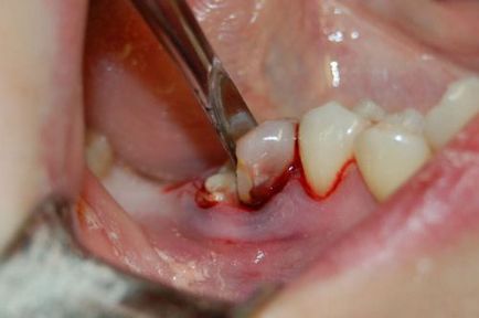 Пломбують зуби мудрості, чи варто лікувати або краще видалити