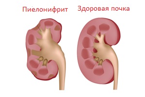 Insuficiența renală și tratamentul tensiunii arteriale