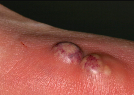 Bőr alatti zsír tumor lábán