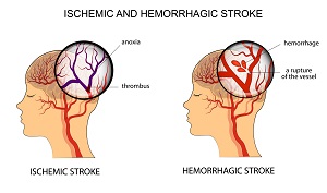 Cauzele accidentului vascular cerebral Cauzele principale ale accidentului vascular cerebral