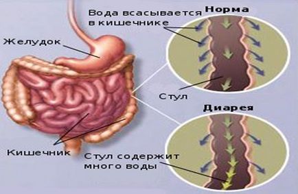 Причини проносу, діареї, виникнення рідкого стільця у дорослих, чому виникає розлад