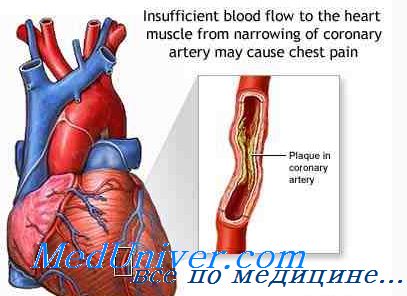 Jelek a mellkasi aorta ateroszklerózis