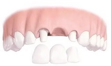 Проблеми, що виникають при протезуванні зубів, мережа стоматологічних клінік